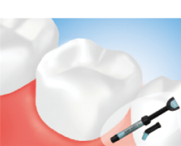 Place composite resin