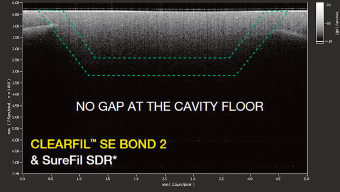 NO GAP AT THE CAVITY FLOOR