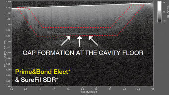 GAP FORMATION AT THE CAVITY FLOOR
