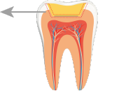 Gap formation at the cavity floor