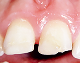 Intraoral Repair