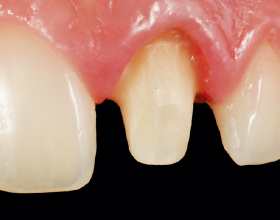 Post Cementation Core Build-Up