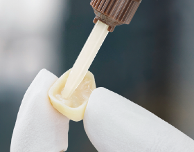 Cementation Indirect Restoration
