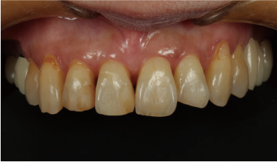 Initial status before six veneers preparation by Dr. Yohei Sato