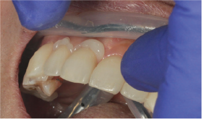 Veneer seating and excess cement removal with PANAVIA™ Veneer LC