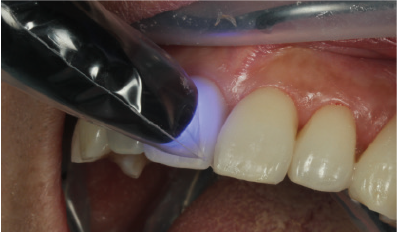 Light curing of each area and margins during veneer cementation