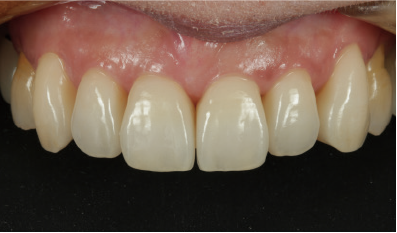 Final result after cementation of six KATANA Zirconia STML veneers