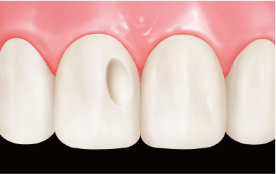Step 1: Prepare the cavity and apply bonding