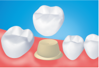 Crowns