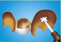 Adhesion bridges