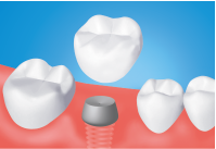 Restorations on implant abutment