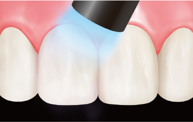 Step 3: Light-cure the composite resin